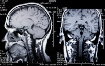 What is an MRI Scan?