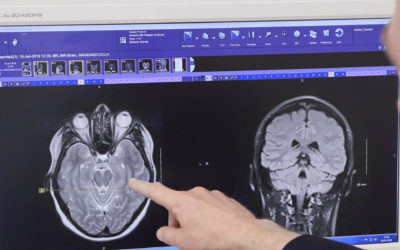 Epilepsy and Seizures – Patient Guide