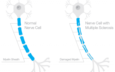 Multiple Sclerosis and Inflammation of the Nervous System