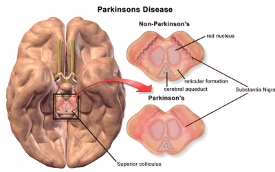 Parkinson’s Disease Stages